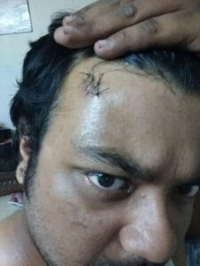 4 Stitches no forehead